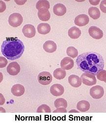 Diagnóstico da anemia e deficiência de ferro Exames laboratoriais Hemograma