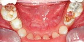 Há vários tipos de mantenedores, removíveis ou fixos e funcionais ou não-funcionais, selecionados de acordo com a idade e colaboração do paciente, com o número de dentes ausentes na região do arco
