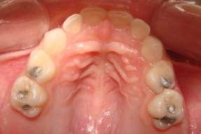 Um aparelho removível deve ser construído de modo a manter a relação dos dentes restantes e para guiar a erupção dos dentes em desenvolvimento, a fim de evitar movimentação anterior dos molares