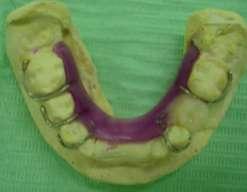 Mantenedores de espaço em ortodontia preventiva e interceptiva. Revista dent. Press ortodontia e ortopedia facial. 1999; 4(5): 25