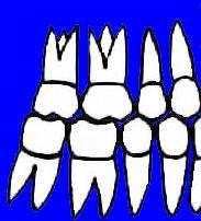 CLASSE II, Subdivisão Ocasionalmente os molares relacionam-se de um lado em Classe II, no