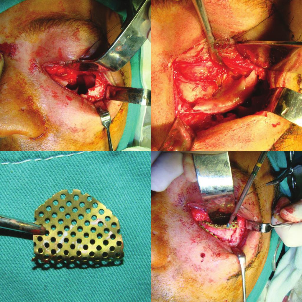 SOUZA BB, ET AL. fratura cominutiva pôde ser observada assim como o conteúdo da órbita que se encontrava dentro do seio maxilar (Fig. 2 A).