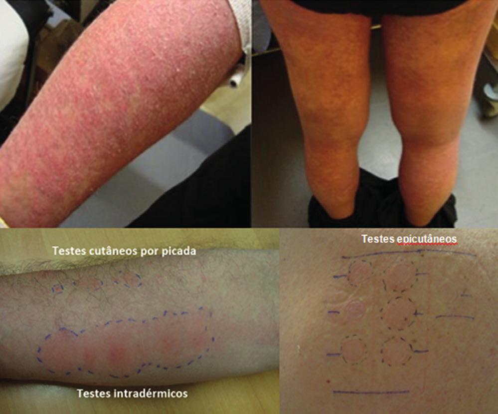 PROVÁVEL SÍNDROME DRESS A MEIO DE CONTRASTE IODADO / CASO CLÍNICO A B A Lesões cutâneas apresentadas pelo doente; B Resultados da leitura às 48 horas dos testes cutâneos aos meios de contraste iodado.