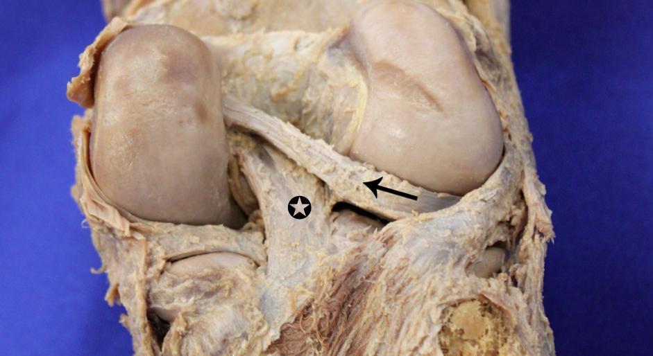 Introdução 21 1.1 Anatomia e biomecânica do ligamento cruzado posterior O ligamento cruzado posterior (LCP) é o maior dos ligamentos intraarticulares do corpo humano.
