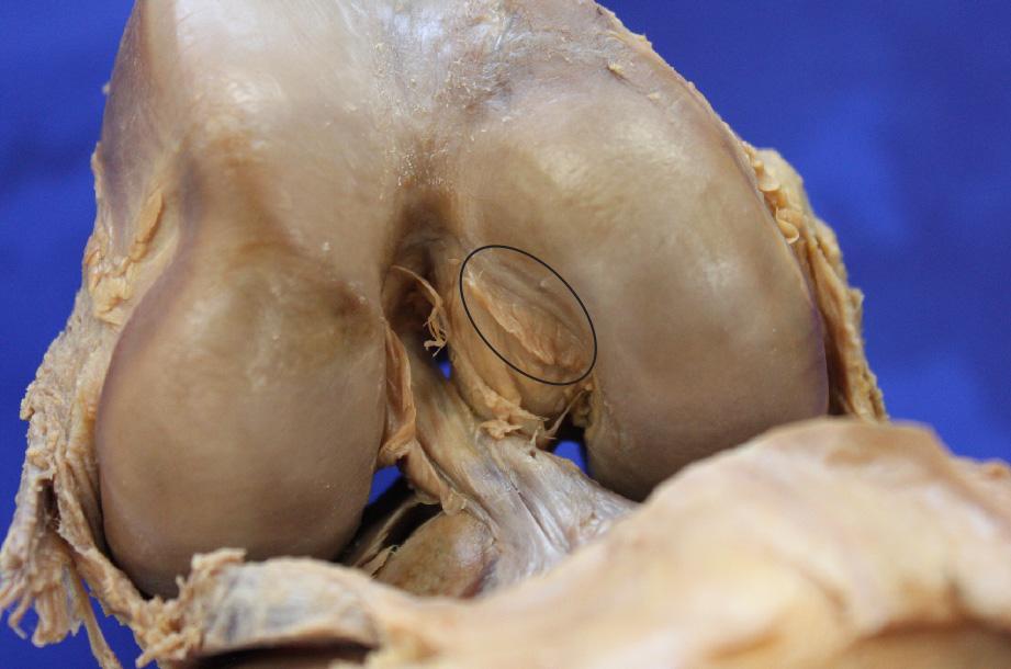 Introdução 23 Figura 3: Peça cadavérica - vista anterior - Inserção do LCP em formato de elipse na face interna do côndilo femoral medial.