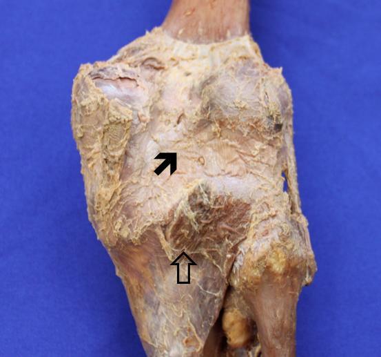 Introdução 27 Figura 6: Peça cadavérica - vista posterior - Cápsula articular do joelho intacta (seta preta) e o músculo poplíteo (seta sem preenchimento).