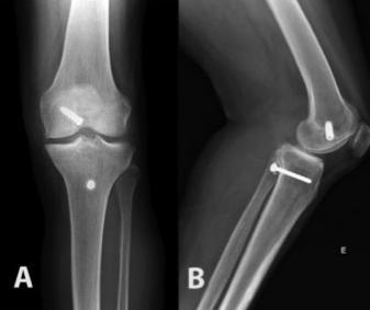 (A) Radiografia nas incidências anteroposterior e (B) lateral do joelho após a reconstrução do LCP pela técnica onlay.