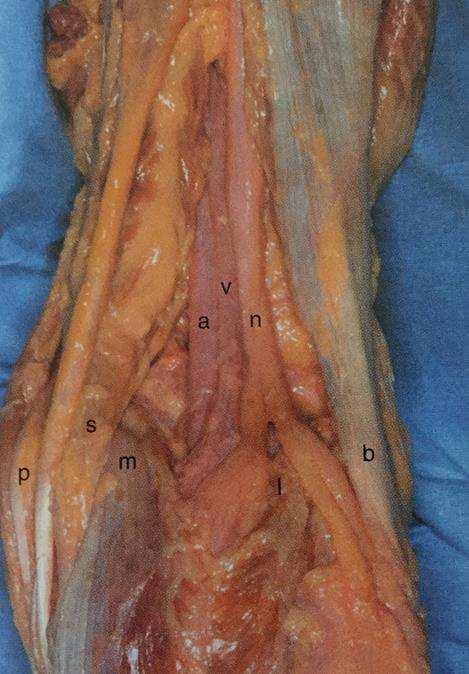 29 Figura 13 Fossa poplítea, feixe vasculo nervoso (Insall, 2012) 1.2.5 Vascularização A artéria femoral antes de passar através do hiato adutor, emite a artéria genicular descendente (Gray,1988).