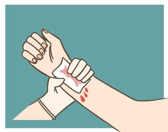 Procedimento: controlar o sangramento Usar barreira de proteção universal: luvas, gazes 1 - Compressão direta sobre a lesão: mãos ou bandagem, gaze seca, ou outro material -
