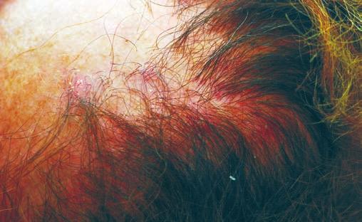 Fig 2 - Detalhe do eritema e descamação na periferia da placa de alopecia. Fig 5 - Após 3 meses de tratamento.