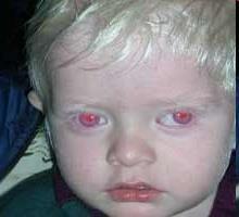 7) Albinismo: falta de melanina característica