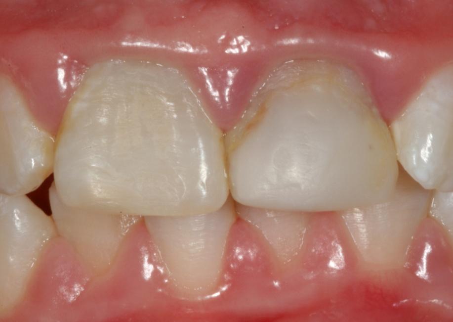 dente, restauração proveniente da época em que a paciente sofreu a fratura.