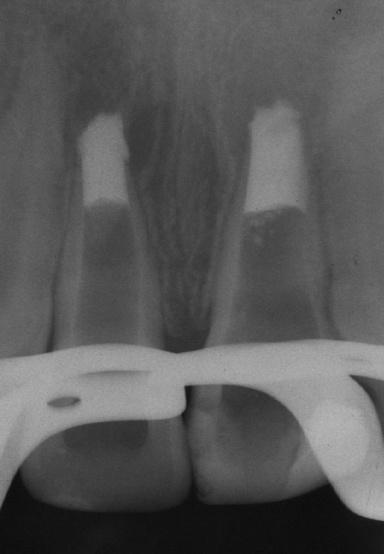 33 FOTOGRAFIA 10: Radiografia dos incisivos com tampão durante a colocação do MTA. FOTOGRAFIA 11: Radiografia da finalização do tampão apical e selamento provisório dos canais radiculares.