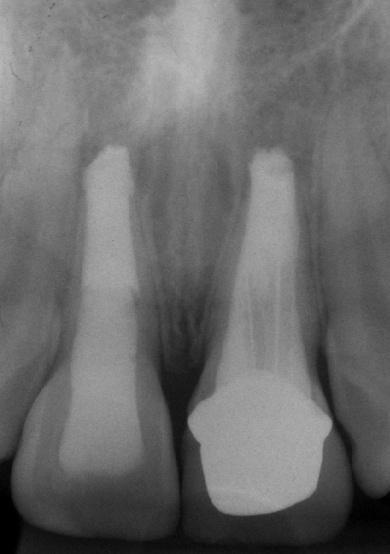 Através de imagens radiográficas e análise clínica pudemos observar a progressão da redução da lesão periapical dentro do período de 9 meses (FOTOGRAFIA