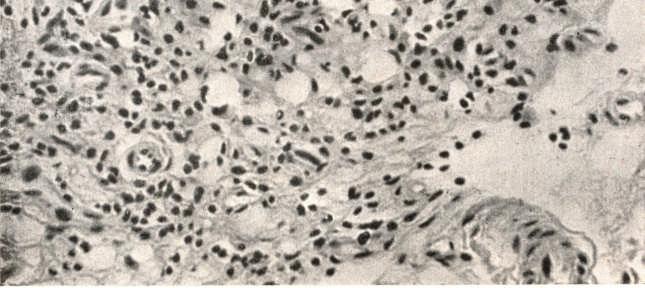 Diagnostico histologico: No corion infiltração inflamatoria cronica perivascular e glandular, com nítida