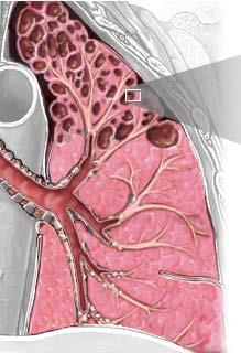 Enfisema