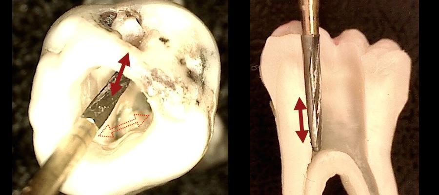 Figura 9 Realização da forma de conveniencia com a broca Endo-Z 3 - Preparo da Entrada do Canal e Desgaste Compensatorio Contínuo Concluída a cirurgia de acesso em dentes sem calcificação pulpar ou