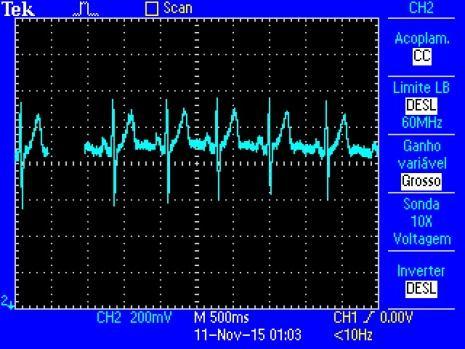 Após a captura, amplificação e condicionamento dos sinais, o microcontrolador PIC16F877A da MICROCHIP, realiza a conversão analógico-digital do sinal, onde apresenta uma resolução 10 bits (PERES,