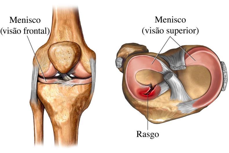 Figura 2.8 Uma lesão de menisco rompido, lesão física ou mecânica, mostra a anatomia da junta do joelho direito.