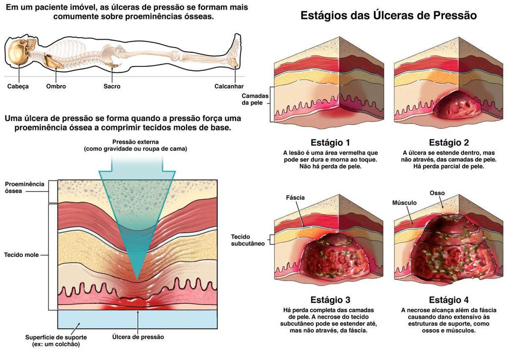 Figura 2.9 Formação de uma ferida por pressão no caso de escara ou úlcera decúbito. Fonte: http://goo.gl/ngyqgg. Acesso em: 12 out.