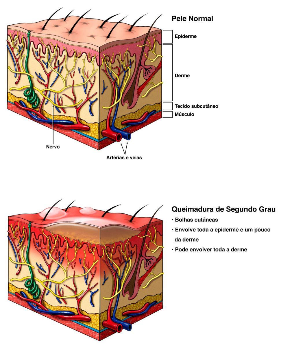 Figura 2.10 A figura superior mostra a anatomia normal da pele, com legendas para epiderme, derme, tecido subcutâneo, músculo, nervo, artérias e veias.