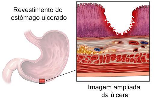 Figura 2.11 Úlcera gástrica aguda reversível quando tratada. A lesão ainda está atingindo o epitélio da camada produtora de muco, mas não atingiu camada muscular nem vasos sanguíneos.