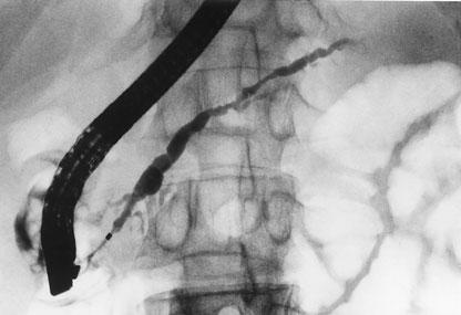 endoscópicos e litotripsia