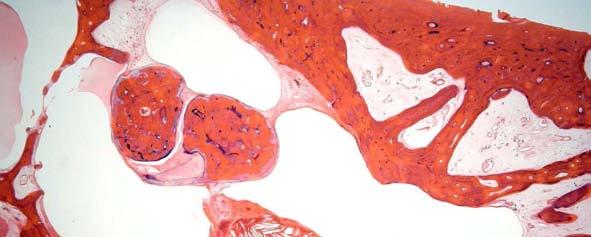 Figura 6: OTH com granuloma de colesterol (seta) localizado no ático, adito e antro da mastóide 3.2.5.