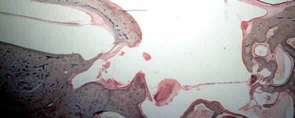 Observa-se espessamento da membrana timpânica (seta