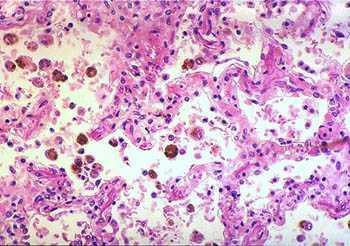 3.4. Congestão Pulmonar Crônica Congestão venosa passiva crônica Macrófagos carregados de hemossiderina 13 3.5.