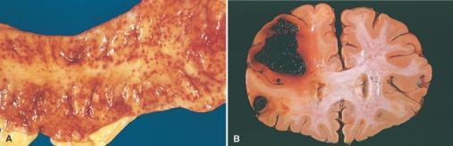 4. Hemorragia 16 Extravasamento de sangue dos vasos Ruptura de artéria ou veia Devido: várias doenças clínicas (diásteses hemorrágicas); trauma; aterosclerose; inflamação; tumor Padrões distintos: