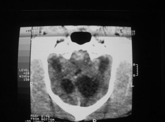 Fig.1- Assimetria de ventrículos Fig.