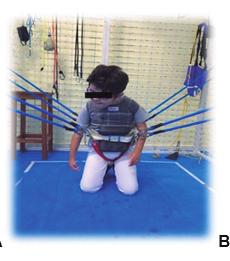As intervenções em ambas as crianças consistiram na utilização das gaiolas monkey (figura 1A) para fortalecimento, e spider (figura 1B) para trocas posturais, ortostatismo e estímulo vestibular