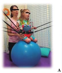 Foram utilizados bolas, rolos, pranchas e discos proprioceptivos, traje PediaSuit (figura 2B) e outros recursos pertinentes à fisioterapia, sempre adequando às necessidades de cada paciente.