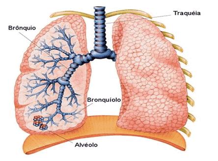 Processo inflamatório intenso - debris por necrose celular e secreção; O diâmetro reduzido do bronquíolo do lactente contribui para a intensidade do