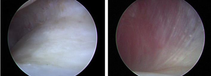 33 Figura 14 Zona intermediária: visão artroscópica A B Legenda: (A) compatível com normalidade saudável, (B) áreas focais de hiperemia.