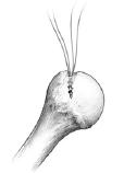 A ancoragem do Parafuso Âncora IOL nos ossos sadios, é maior do que a resistência dos Fios de Sutura, portanto a limitação a ser considerada é a resistência do Fio de Sutura.