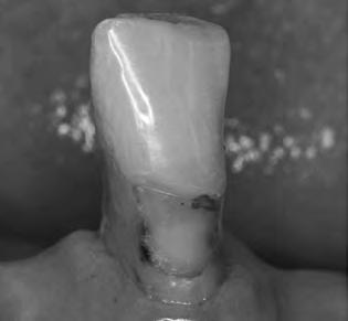 Figura 3 - Restauração cervical com manchamento inaceitável e perda parcial de material, substituição necessária Discussão Este estudo retrospectivo avaliou restaurações classe V, utilizando os