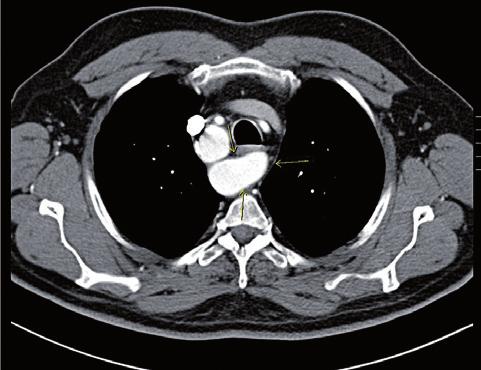 Arco aórtico direito, paratraqueal direito (setas). Figura 1 Radiografia do tórax (póstero-anterior). Acentuação do calibre da crossa da aorta com posicionamento do arco aórtico direito.