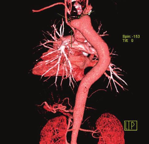 Figura 2D Angio-TC torácica. Reconstrução 3D (vista posterior). Divertículo de Kommerell (setas). cerca de 0,05% a 0,1% em séries radiológicas 1, e em 0,04% a 0,1% de séries de autópsias 2.
