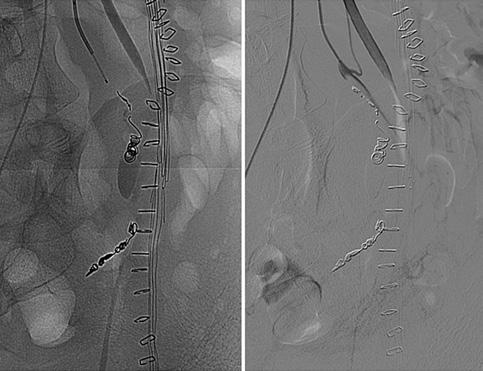 Inferior mesenteric artery primary pseudoaneurysms are rare but potentially fatal, with formal indication for treatment, given the risks of free rupture.