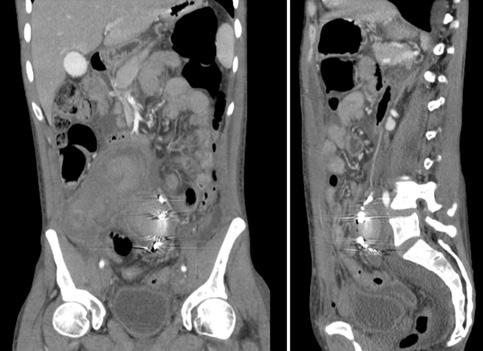 RESULTADO O procedimento decorreu sem qualquer complicação. Na angiografia final não se evidenciou preenchimento do saco aneurismática, tanto por via anterógrada como retrógrada (Fig. 2).