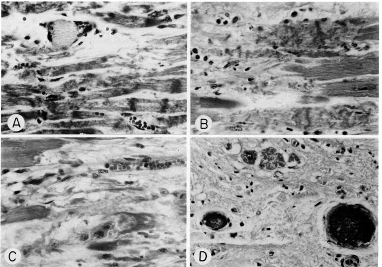 Redução da reserva coronária, disfunção da microcirculação e fibrose miocárdica Bulkley, BH., et al.