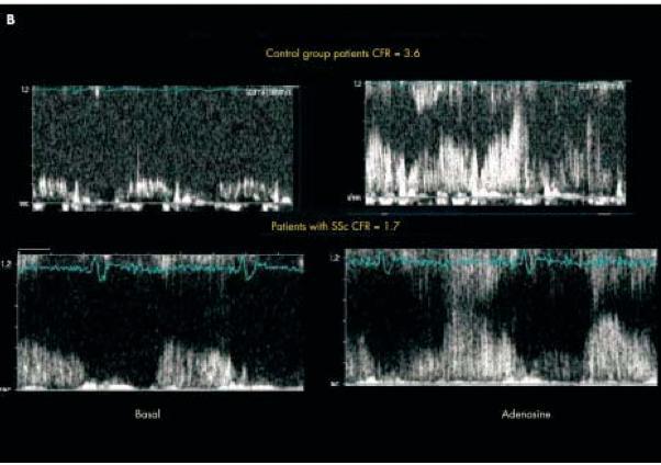 : Detection of early impairment of coronary flow