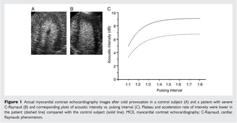 Associação entre disfunção microcirculatória e miocárdica Mizumo, R., et al.