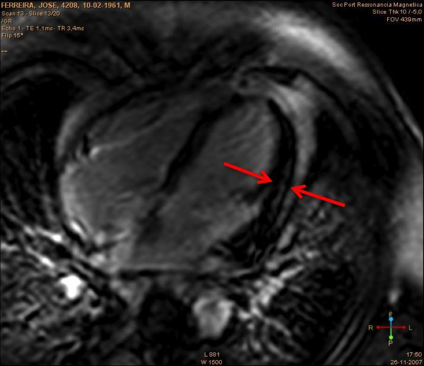 MYOCARDIAL FIBROSIS IN SYSTEMIC SCLEROSIS Impact in ventricular function and clinical presentation Gustavo Lima da Silva ; Ana G. Almeida; Catarina Resende; João S.