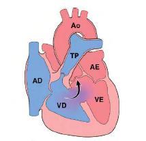 Qual a cardiopatia representada e quais as malformações a caracterizam?