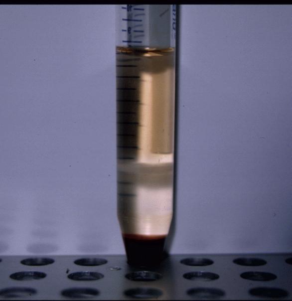 Separação de células sanguíneas Centrifugação em gradiente Envolve a separação de partículas com base na sua massa e forma numa solução de densidade e/ou concentração decrescente A amostra é colocada