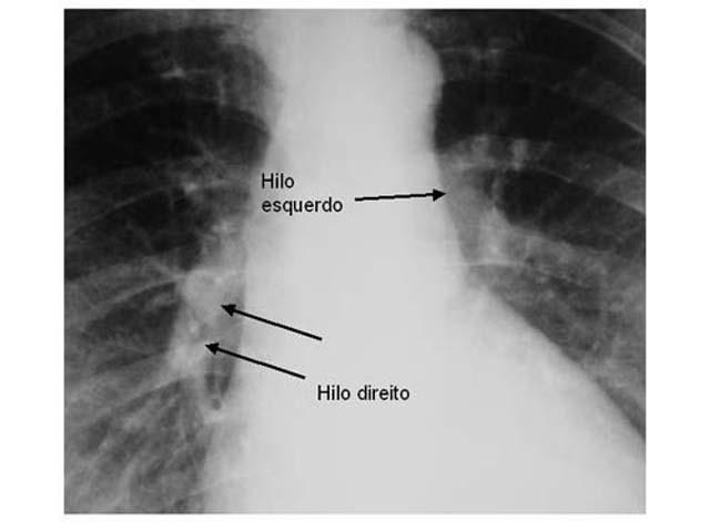 Interpretação do Rx tórax - PA 1.De fora para dentro - Iniciar análise pelas partes moles, depois arcos costais, clavículas, pulmões e mediastino 2.