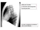 -Corresponde ao espaço interpleural entre os dois pulmões - É composto, basicamente, pelo: coração / timo vasos da base (aorta, veia cava superior, veias